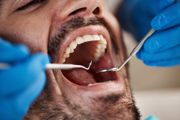 Best Dental Abscess Treatment in Lillian, AL